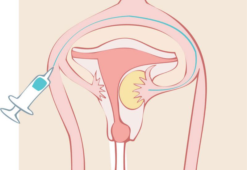 Embolização: técnica trata miomas uterinos