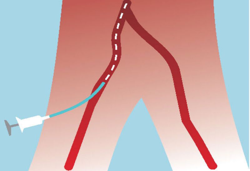 Tratamento de aneurismas cerebrais sem cirurgia aberta